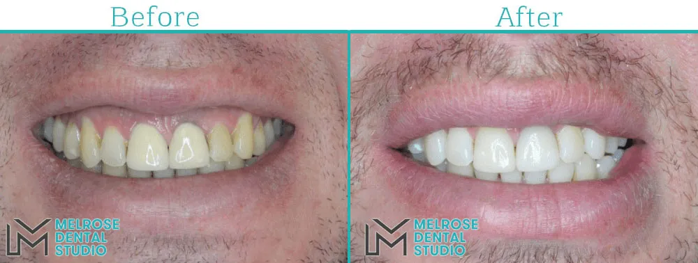 Before and after of a same-day CEREC ceramic crown at Melrose Dental Studio, case 3