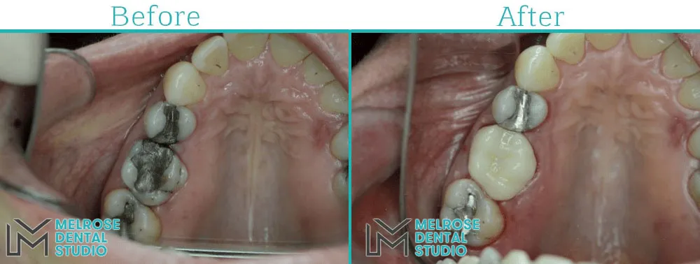 Before and after of a same-day CEREC ceramic crown at Melrose Dental Studio, case 4
