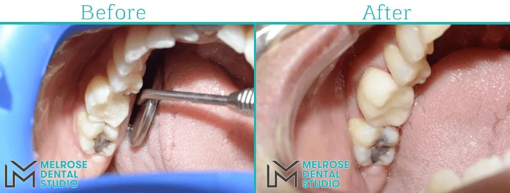 Before and after of a same-day CEREC ceramic crown at Melrose Dental Studio, case 5