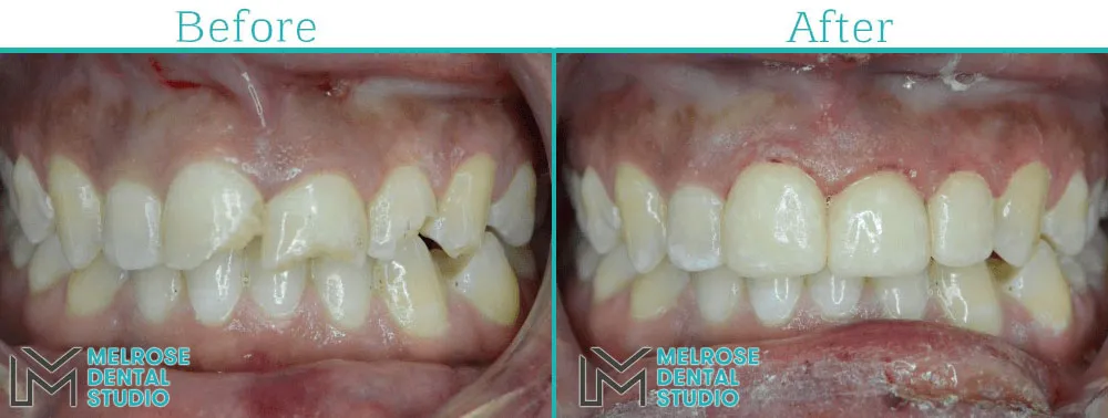 Before and after of a same-day CEREC ceramic crown at Melrose Dental Studio, case 6
