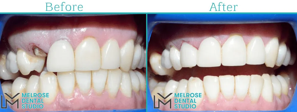 Before and after of a same-day CEREC ceramic crown at Melrose Dental Studio, case 7
