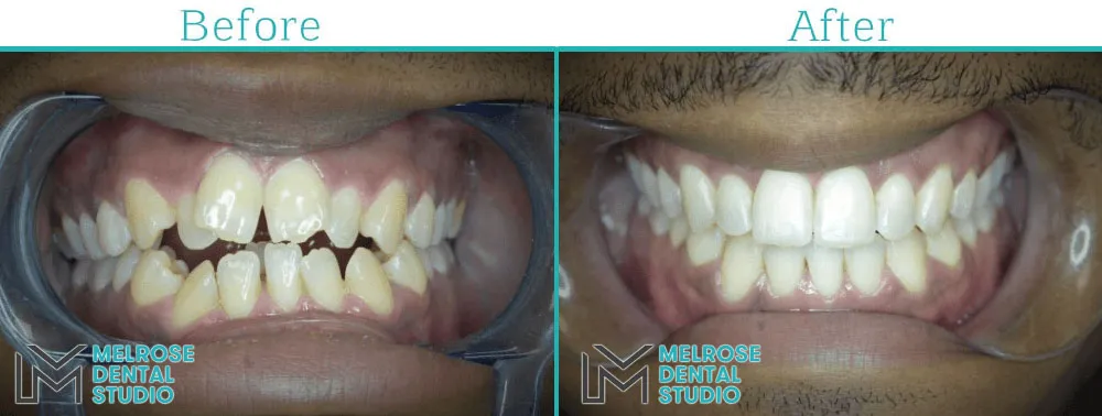 Invisalign aligner before and after result at Melrose Dental Studio
