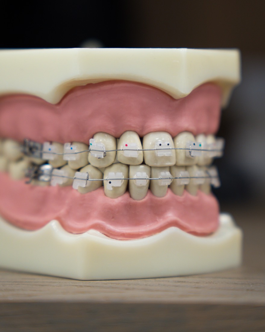 Model comparing clear aligners with fixed braces